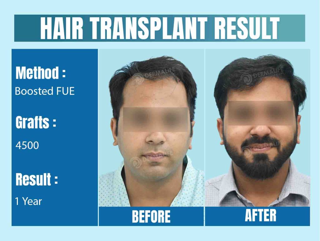 Best Hair Transplant in Delhi: A Fine Mix of Accuracy and Imagination